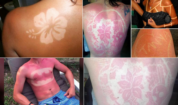 sunburn-art_69457